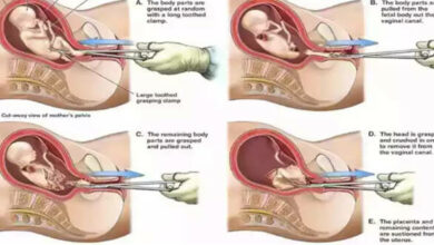 dismemberment abortion