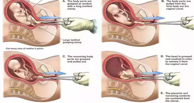 dismemberment abortion