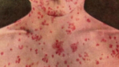 asbury measles