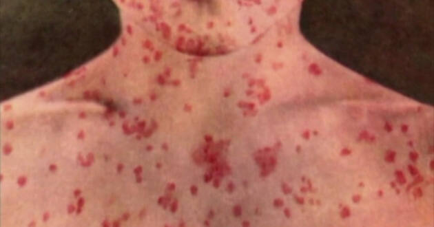 asbury measles